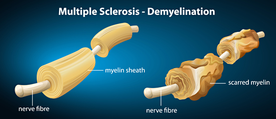 Multiple Sclerosis - Demylination