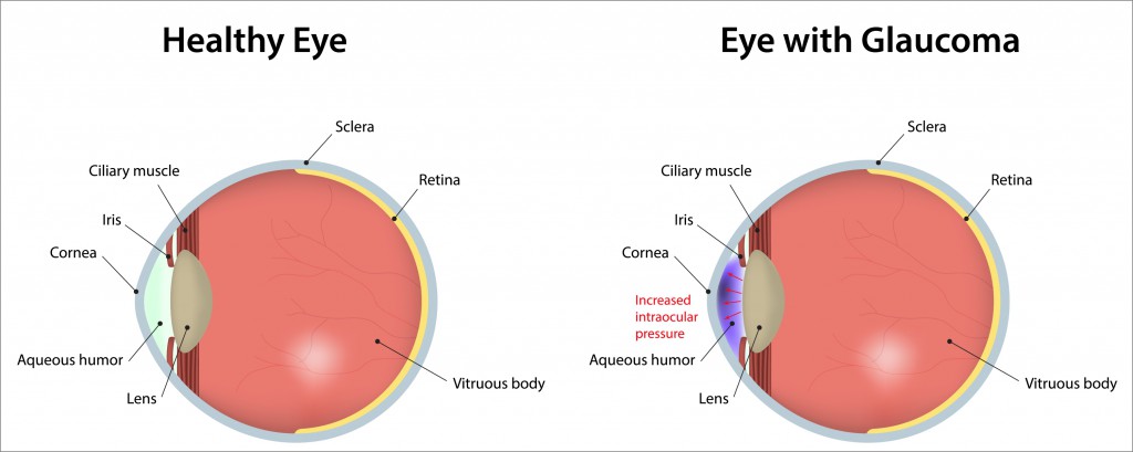 Eye-With-Glaucoma